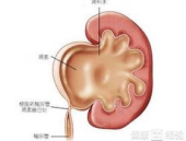 肾积水症状,全面了解腰痛、肿块及其他并发症